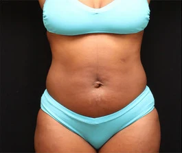 Before Liposuction: Oblique view of abdomen area showing excess fat deposits
