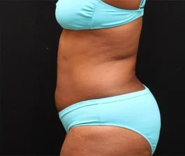 Before Liposuction: Back view showing areas of fat accumulation