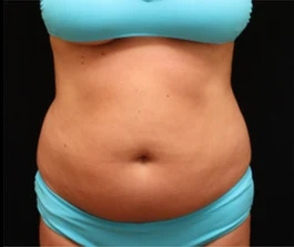 Before Liposuction: Profile view showing areas targeted for fat reduction