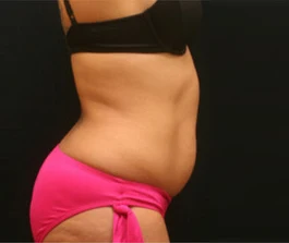 Before Liposuction: Front view highlighting treatment areas
