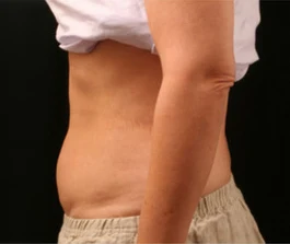 Before Liposuction: Front view highlighting treatment areas