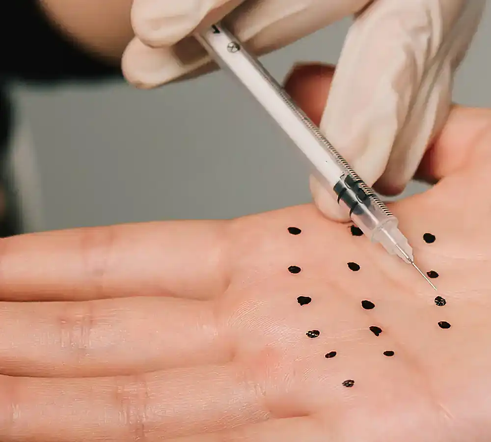Radiesse® filler treatment results