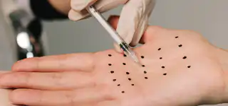 Radiesse® filler for lifting and contouring