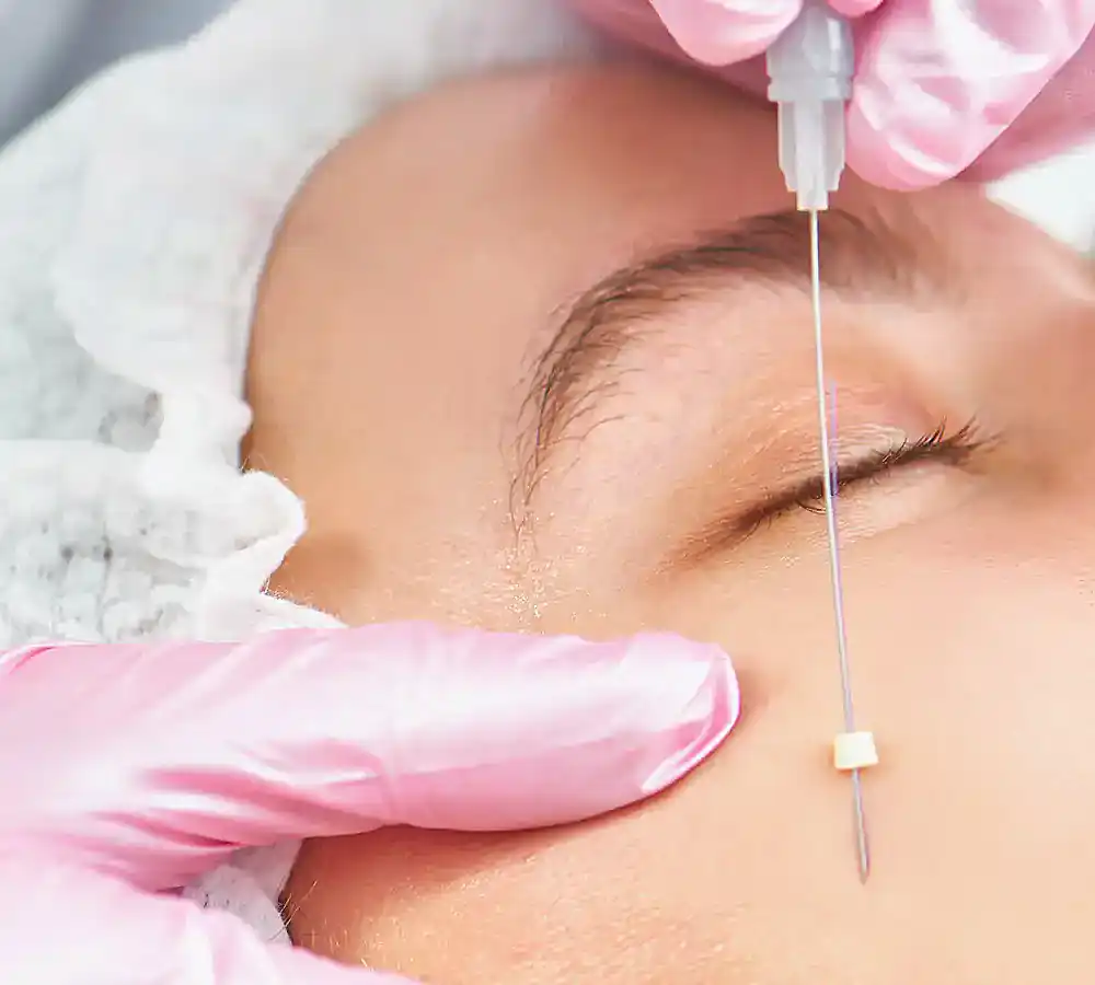 Sugar Thread Lift procedure and results