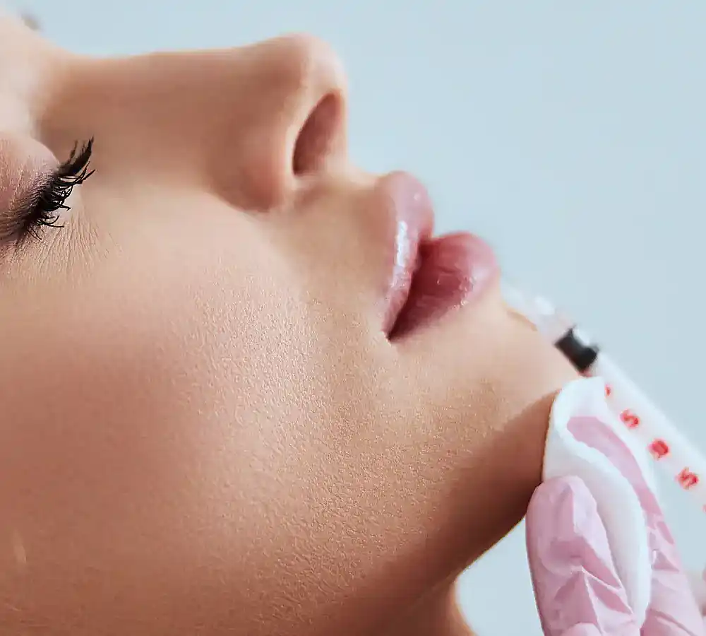Natural results achieved with Versa dermal filler
