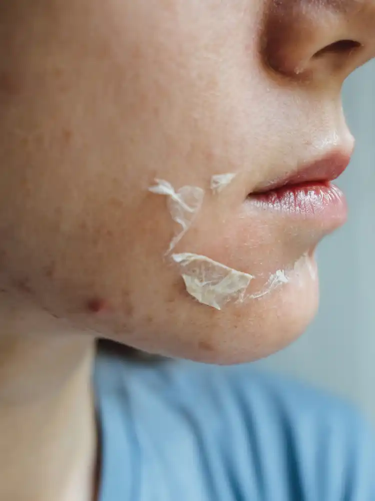 VI Peel treatment transformation showing beautiful, clear skin results