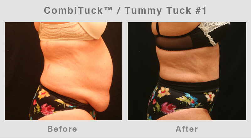 Memphis CombiTuck - Tummy Tuck with Liposuction Example 1