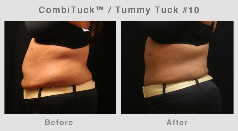 Memphis CombiTuck - Tummy Tuck with Liposuction Example 10
