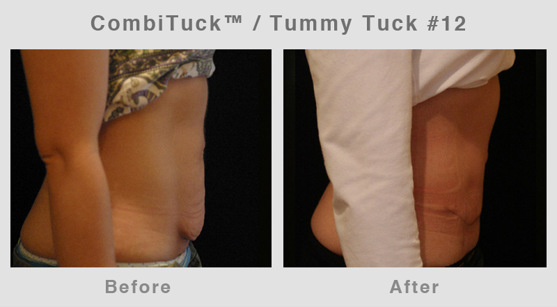 Memphis CombiTuck - Tummy Tuck with Liposuction Example 12