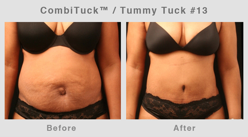 Memphis CombiTuck - Tummy Tuck with Liposuction Example 13