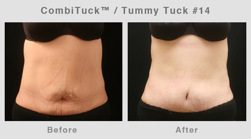 Memphis CombiTuck - Tummy Tuck with Liposuction Example 14
