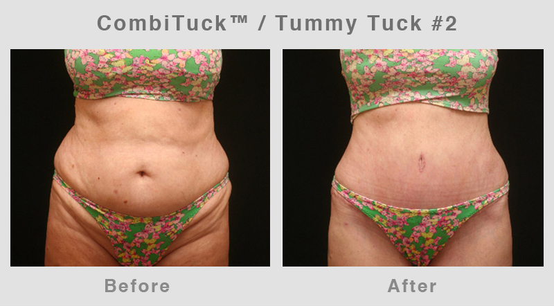 Memphis CombiTuck - Tummy Tuck with Liposuction Example 2