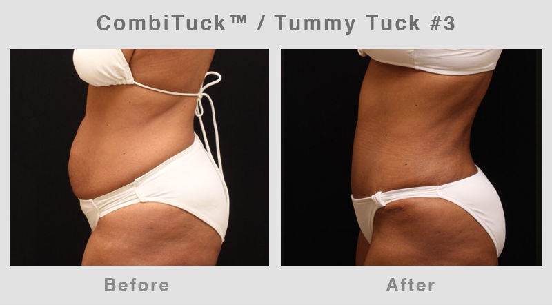 Memphis CombiTuck - Tummy Tuck with Liposuction Example 3