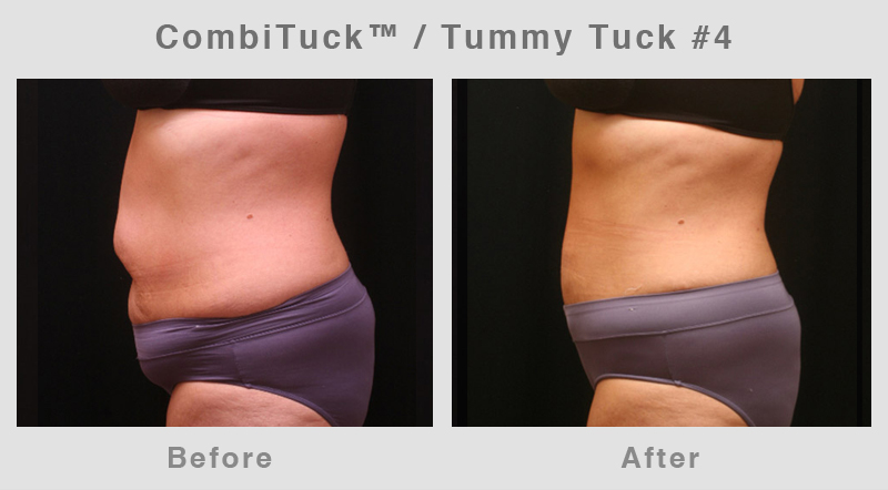 Memphis CombiTuck - Tummy Tuck with Liposuction Example 4