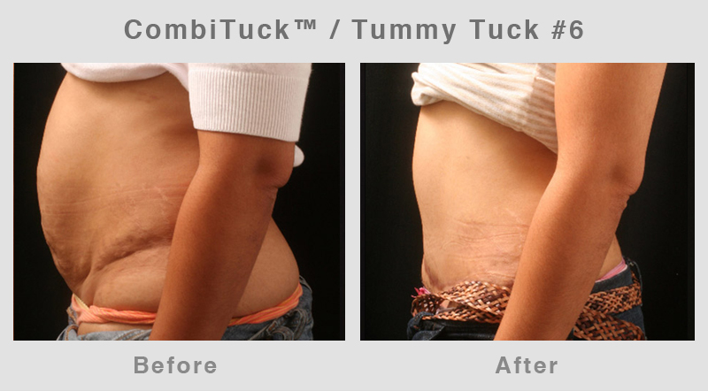 Memphis CombiTuck - Tummy Tuck with Liposuction Example 6