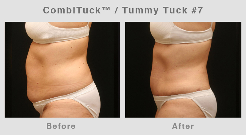 Memphis CombiTuck - Tummy Tuck with Liposuction Example 7