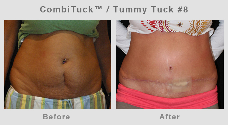 Memphis CombiTuck - Tummy Tuck with Liposuction Example 8