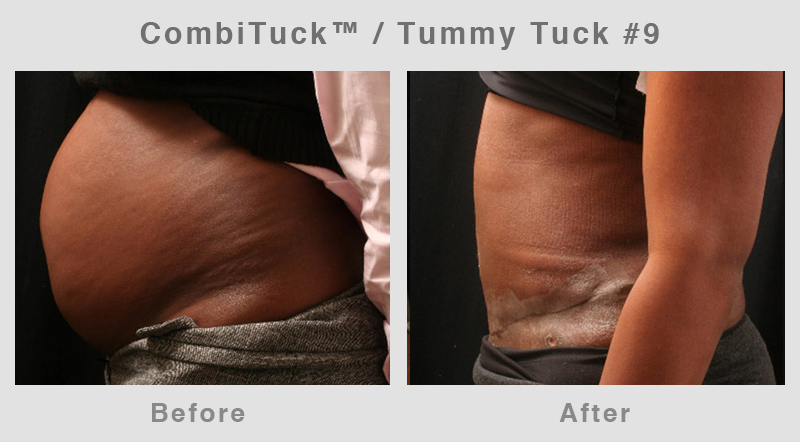 Memphis CombiTuck - Tummy Tuck with Liposuction Example 9