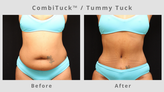 Memphis CombiTuck - Tummy Tuck with Liposuction 1