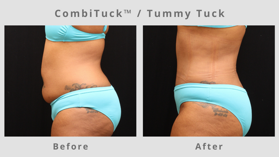 Memphis CombiTuck - Tummy Tuck with Liposuction Example 2