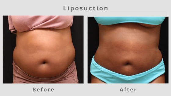 Memphis Liposuction & Fat Removal Example 1