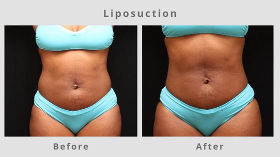 Memphis Liposuction & Fat Removal Example 3