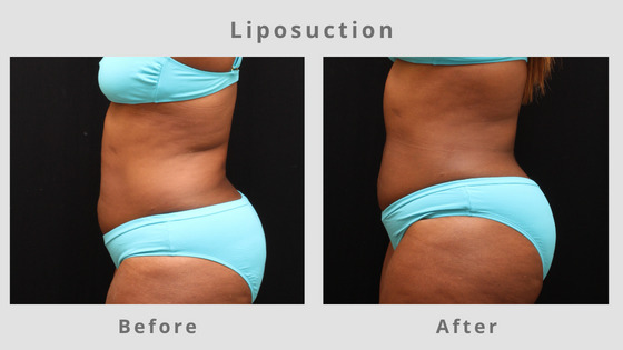 Memphis Liposuction & Fat Removal Example 4