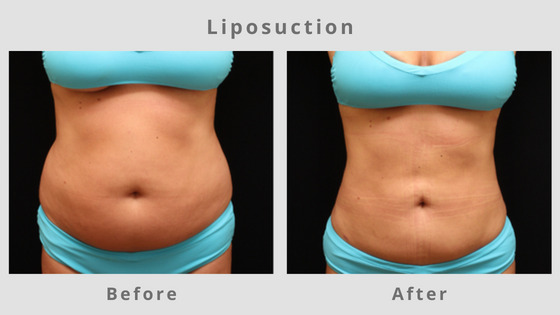 Memphis Liposuction & Fat Removal Example 5