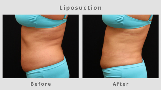 Memphis Liposuction & Fat Removal Example 6