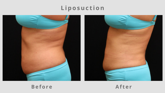 Memphis Liposuction, Surgical Fat Removal