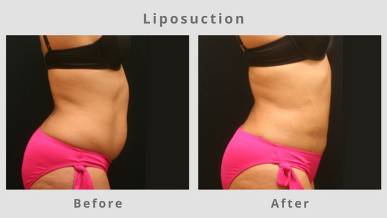 Memphis Liposuction & Fat Removal Example 7