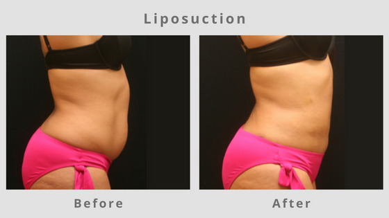 Memphis Liposuction, Surgical Fat Removal