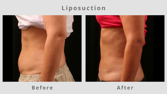 Memphis Liposuction & Fat Removal Example 8