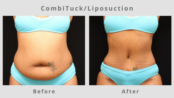 Memphis Liposuction & Fat Removal Example 9