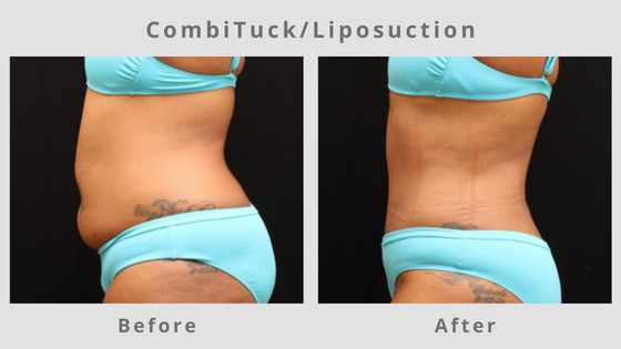 Memphis Liposuction & Fat Removal Example 10